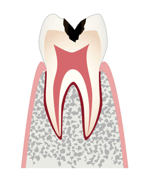 歯の内部まで進行したむし歯