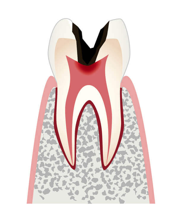 神経まで進行したむし歯